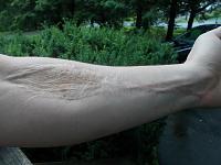Click image for larger version.&nbsp;

Name:	ScarWithGraft.jpg&nbsp;
Views:	86&nbsp;
Size:	59.3 KB&nbsp;
ID:	37018