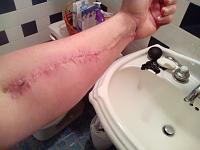 Click image for larger version.&nbsp;

Name:	ScarHealing.jpg&nbsp;
Views:	85&nbsp;
Size:	60.2 KB&nbsp;
ID:	37019